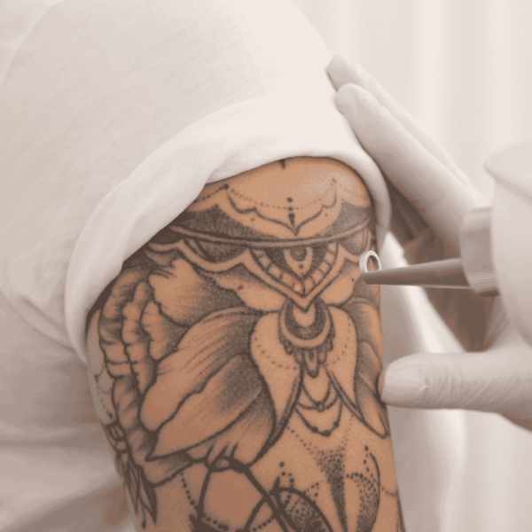 Eliminación de Tatuajes por cm²